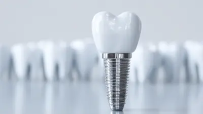 How to Choose the Right Dental Implant for Your Needs
