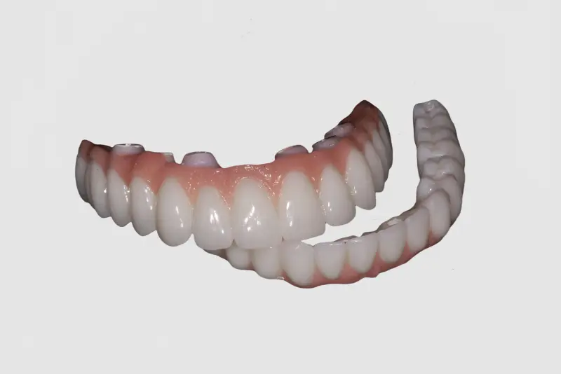 Screw-Retained Hybrid Denture (3).jpg