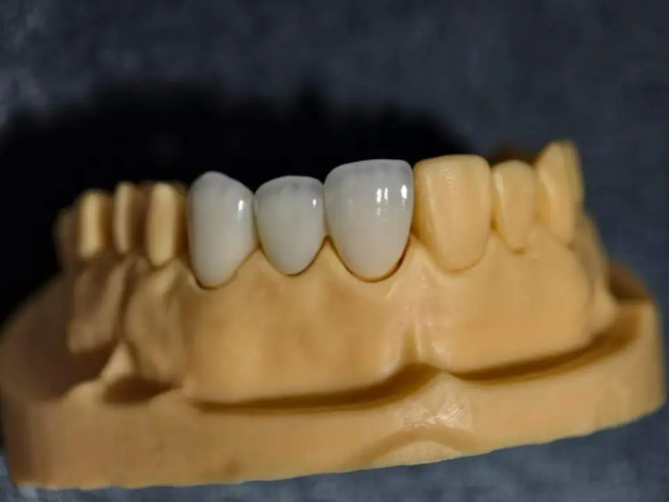 Why Overseas Dental Labs Are Outsourcing Dental Crown & Bridge Cases to a Chinese Dental Lab