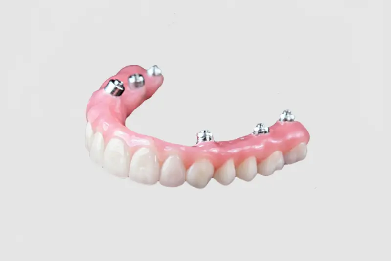 Screw-Retained Hybrid Denture (1).jpg