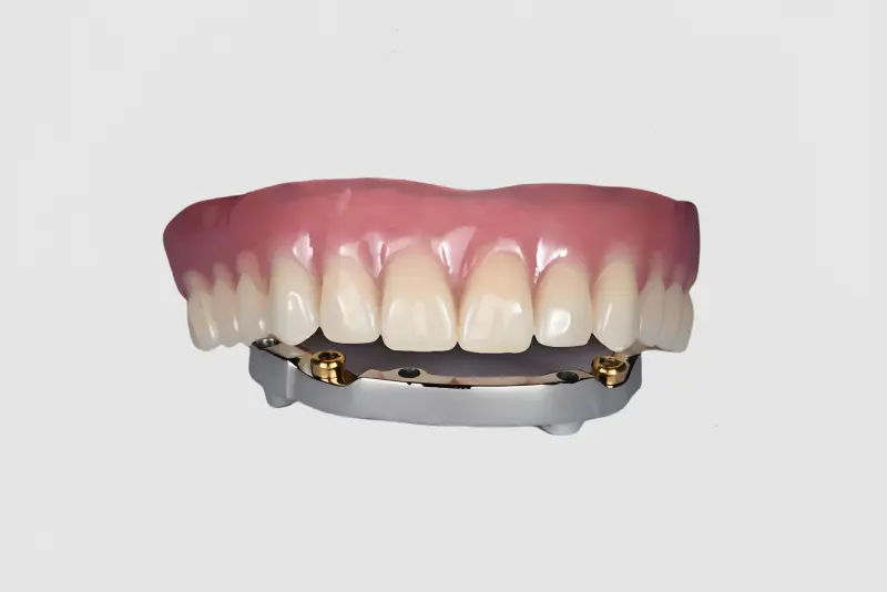 Bar-Cage Implant-Covered Denture (2).jpg