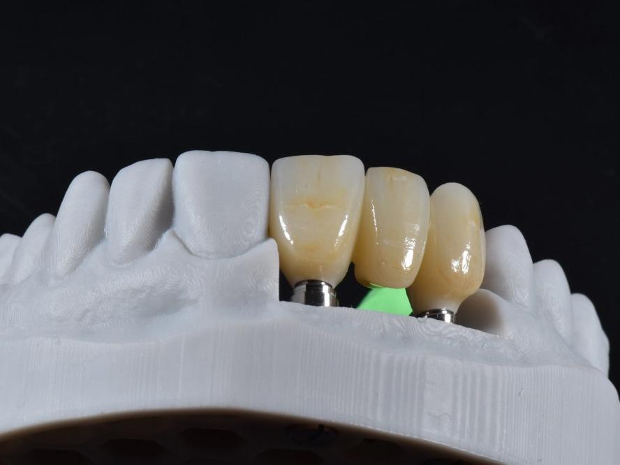 Aesthetic Perfection: A Visual Showcase of Premium Implant Restoration Cases