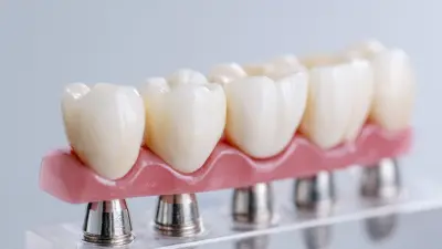 How to Choose the Right Ceramic Bridges for Your Dental Needs